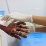 Que faire en cas de brûlures ?
