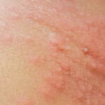 Éruption cutanée due à une chenille processionnaire ? Que faire ?